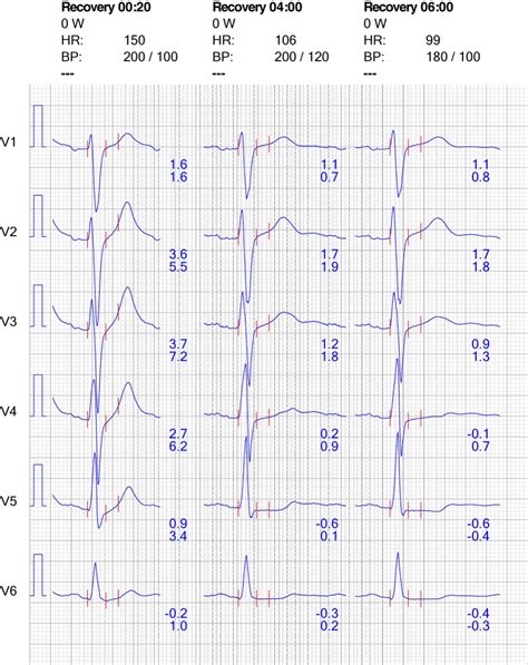 abnormal ekg results|abnormal ekg results stress test.